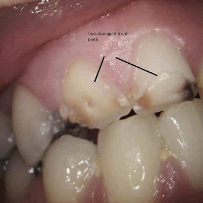  Close view of two damaged front teeth from an accident. Both teeth lost vitality and were restored with traditonal crown technique